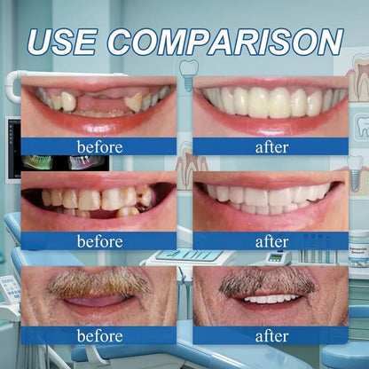 🌎Ends Today: Ends Today: 70% OFF! ⏰Eluviax® Medical Full Denture with Strong Suction🦷“Get Your Natural Smile Back — No Expensive Dental Work Needed”